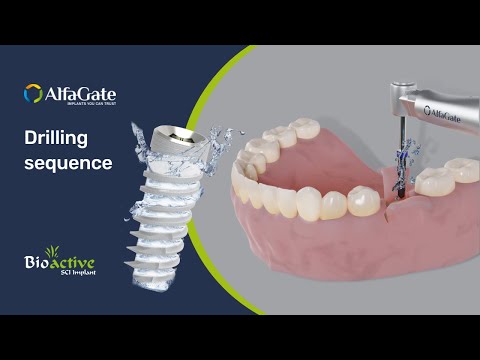 Introducing Bioactive Implants: Ideal for challenging cases, including compromised bone density. Features resorbable calcium phosphate surface, attracting stem cells for accelerated healing in 6-10 weeks. Crafted from Titanium Alloy Ti 6Al 4V ELI with biocompatible CaP Hydrophilic surface.