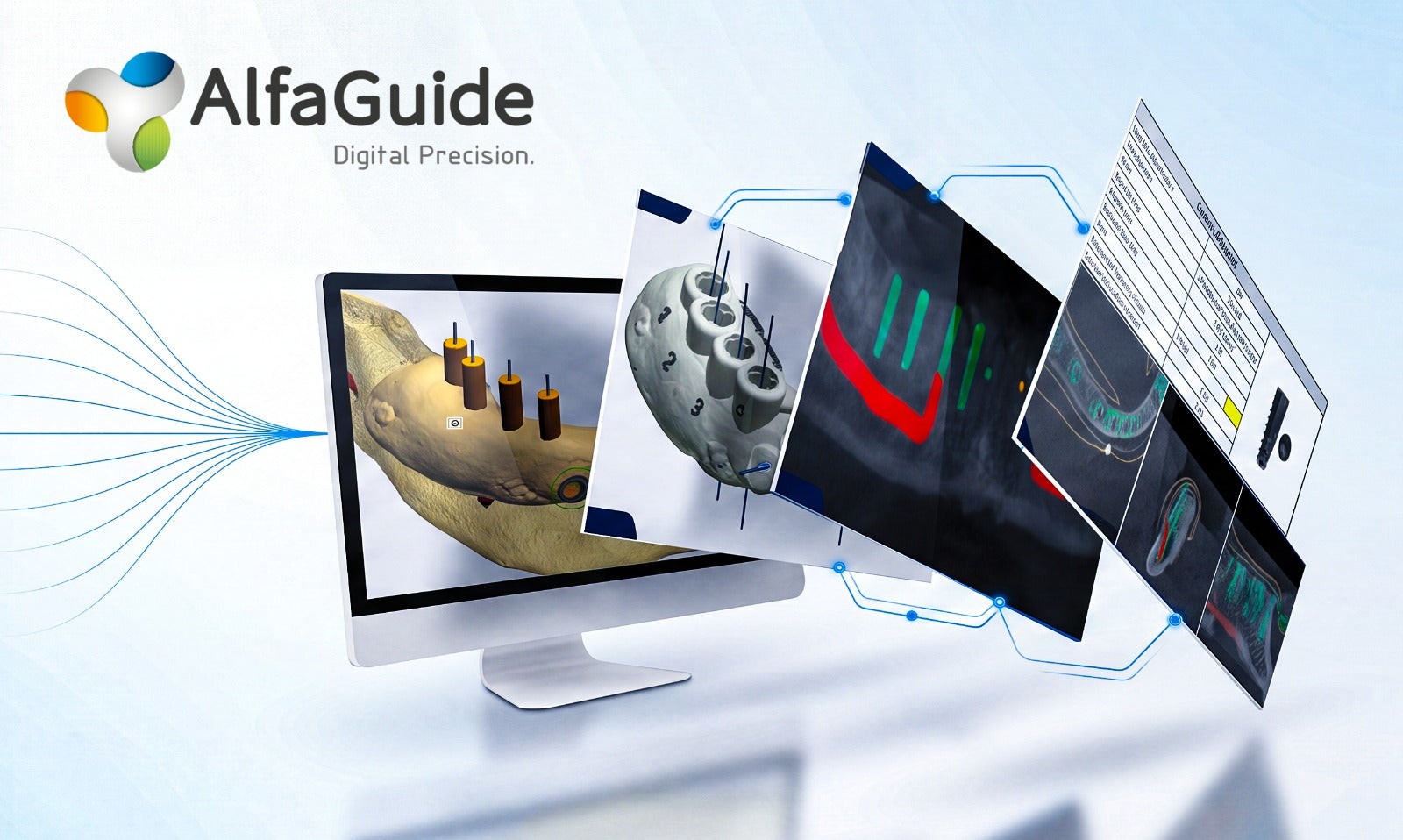 AlfaGuide digital guided surgery planning workflow with clinical case upload and STL delivery